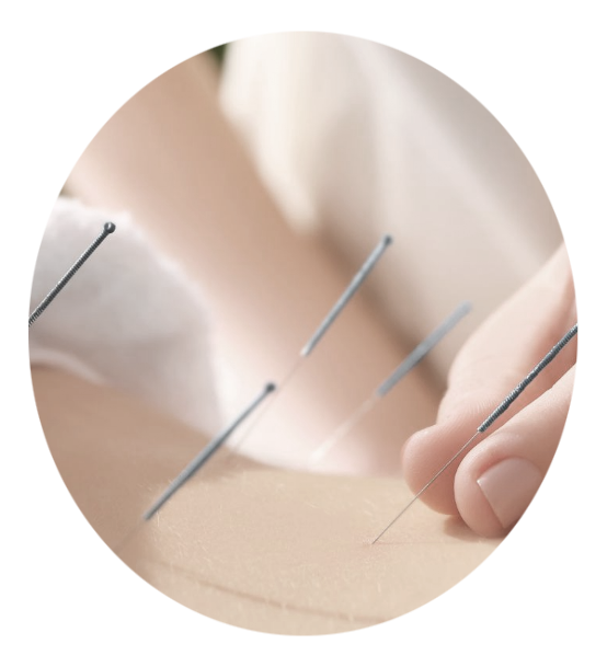 Photo d'une séance d'acupuncture du dos